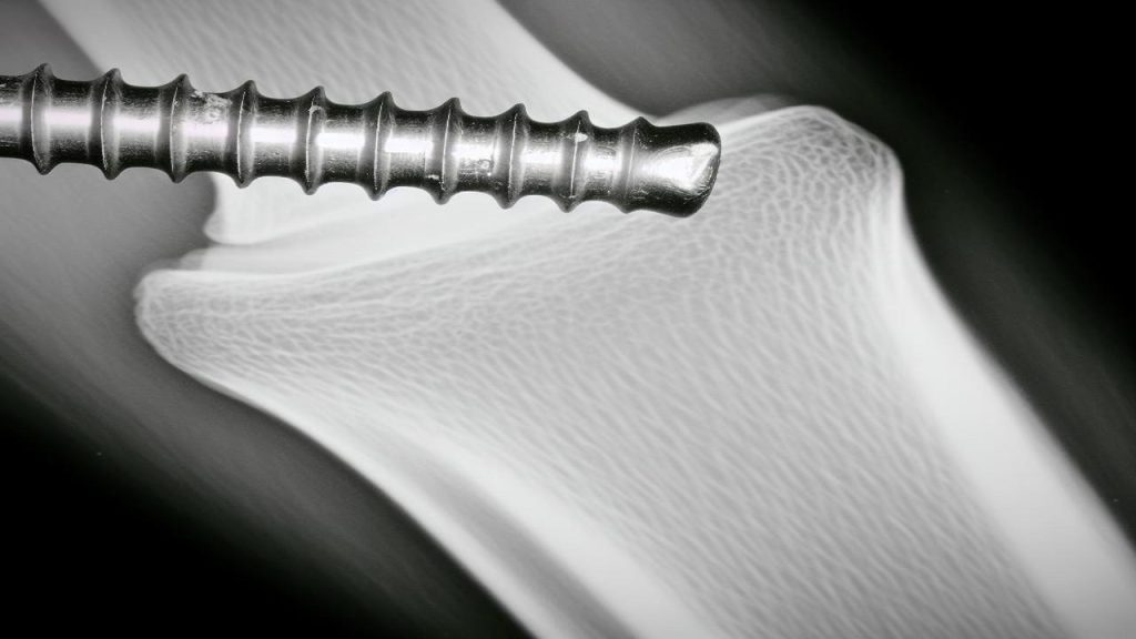 Jak długo goją się kości po wyjęciu śrub?